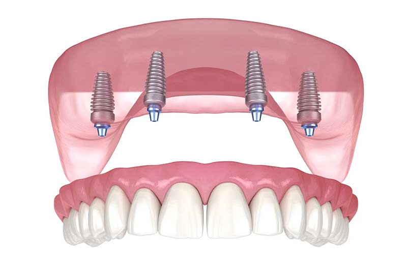 All-on-4 Implants in Pflugerville and Round Rock