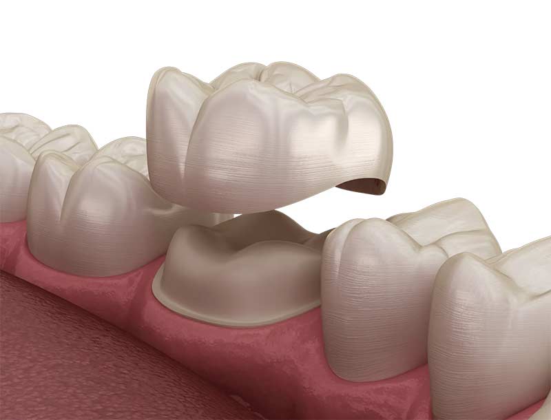 Dental Crowns | Kyle & Austin TX