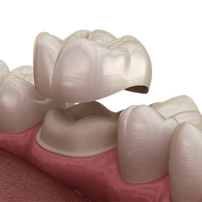 Dental Crowns in Pflugerville and Round Rock