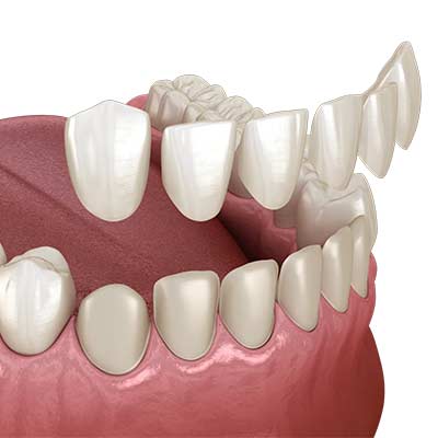 Dental Veneers in Pflugerville and Round Rock