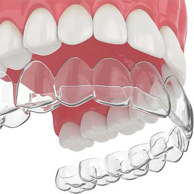 Clear Aligners in Pflugerville and Round Rock